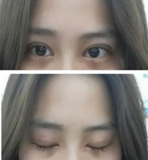 定點雙眼皮怎么做？定點雙眼皮需要拆線嗎？