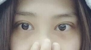 定點雙眼皮怎么做？定點雙眼皮需要拆線嗎？