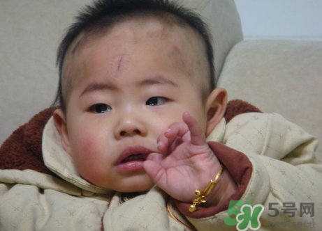 新生兒身上有青塊是怎么回事?是什么原因? 新生兒身上有青塊是怎么回事?是什么原因?