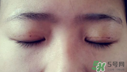 埋線雙眼皮需要拆線嗎？埋線雙眼皮怎么拆線