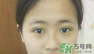 埋線雙眼皮需要拆線嗎？埋線雙眼皮怎么拆線