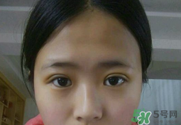 埋線雙眼皮需要拆線嗎？埋線雙眼皮怎么拆線