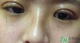 埋線雙眼皮需要拆線嗎？埋線雙眼皮怎么拆線