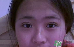 埋線雙眼皮需要拆線嗎？埋線雙眼皮怎么拆線