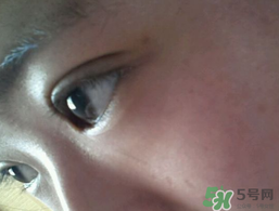 埋線雙眼皮需要拆線嗎？埋線雙眼皮怎么拆線