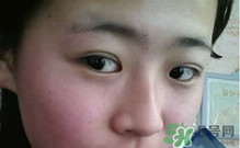 埋線雙眼皮需要拆線嗎？埋線雙眼皮怎么拆線