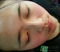 埋線雙眼皮需要拆線嗎？埋線雙眼皮怎么拆線