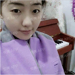 三點(diǎn)雙眼皮恢復(fù)過程圖_韓式三點(diǎn)雙眼皮多久恢復(fù)自然 三點(diǎn)雙眼皮恢復(fù)過程圖_韓式三點(diǎn)雙眼皮多久恢復(fù)自然