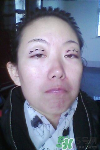 什么是定點(diǎn)雙眼皮？定點(diǎn)雙眼皮多少錢？