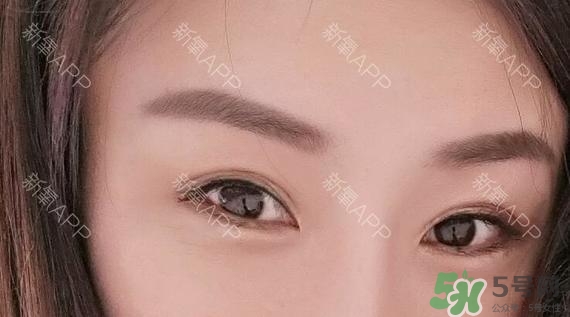 埋線(xiàn)雙眼皮能保持多久？埋線(xiàn)雙眼皮是永久嗎