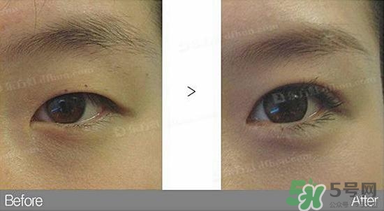 埋線雙眼皮需要拆線嗎？埋線雙眼皮怎么拆線