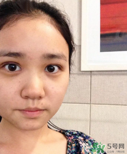 埋線雙眼皮的危害_埋線雙眼皮有風險后遺癥嗎 埋線雙眼皮的危害_埋線雙眼皮有風險后遺癥嗎