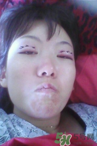 什么是定點(diǎn)雙眼皮？定點(diǎn)雙眼皮多少錢？