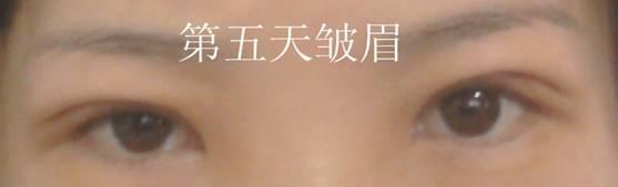 三點雙眼皮恢復(fù)過程圖_韓式三點雙眼皮多久恢復(fù)自然