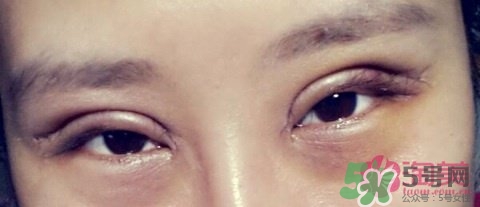切開雙眼皮多久消腫？切開雙眼皮多久恢復(fù)？