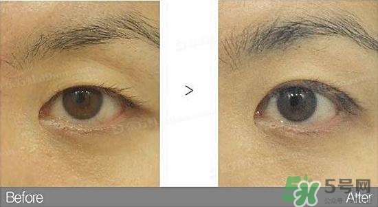 埋線雙眼皮需要拆線嗎？埋線雙眼皮怎么拆線