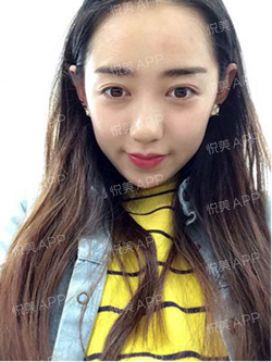 三點(diǎn)雙眼皮恢復(fù)過程圖_韓式三點(diǎn)雙眼皮多久恢復(fù)自然 三點(diǎn)雙眼皮恢復(fù)過程圖_韓式三點(diǎn)雙眼皮多久恢復(fù)自然