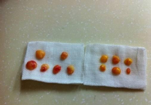 韓式三點(diǎn)雙眼皮是永久嗎？三點(diǎn)雙眼皮能保持多久？