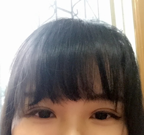 定點(diǎn)雙眼皮恢復(fù)過(guò)程圖_定點(diǎn)雙眼皮要多久恢復(fù) 定點(diǎn)雙眼皮恢復(fù)過(guò)程圖_定點(diǎn)雙眼皮要多久恢復(fù)