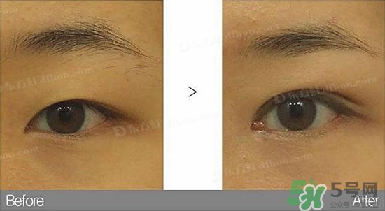 埋線雙眼皮需要拆線嗎？埋線雙眼皮怎么拆線