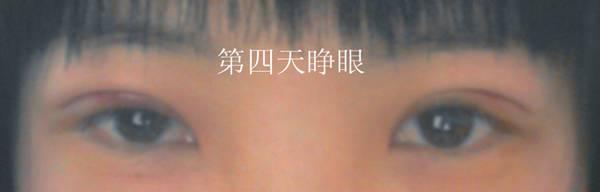 三點雙眼皮恢復(fù)過程圖_韓式三點雙眼皮多久恢復(fù)自然