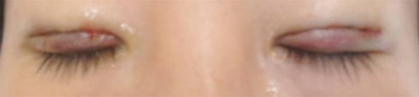 三點雙眼皮恢復(fù)過程圖_韓式三點雙眼皮多久恢復(fù)自然