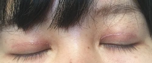 定點(diǎn)雙眼皮恢復(fù)過(guò)程圖_定點(diǎn)雙眼皮要多久恢復(fù) 定點(diǎn)雙眼皮恢復(fù)過(guò)程圖_定點(diǎn)雙眼皮要多久恢復(fù)