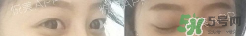 埋線雙眼皮多久恢復(fù)自然？埋線雙眼皮多久能恢復(fù)