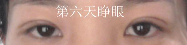 三點雙眼皮恢復(fù)過程圖_韓式三點雙眼皮多久恢復(fù)自然