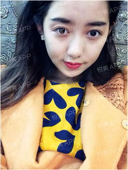 三點(diǎn)雙眼皮恢復(fù)過程圖_韓式三點(diǎn)雙眼皮多久恢復(fù)自然 三點(diǎn)雙眼皮恢復(fù)過程圖_韓式三點(diǎn)雙眼皮多久恢復(fù)自然