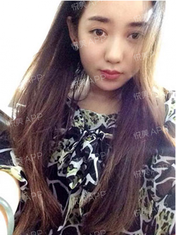 三點(diǎn)雙眼皮恢復(fù)過程圖_韓式三點(diǎn)雙眼皮多久恢復(fù)自然 三點(diǎn)雙眼皮恢復(fù)過程圖_韓式三點(diǎn)雙眼皮多久恢復(fù)自然