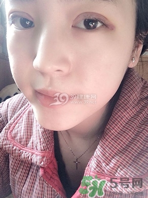 什么是定點(diǎn)雙眼皮？定點(diǎn)雙眼皮多少錢？