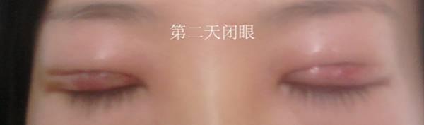 三點雙眼皮恢復(fù)過程圖_韓式三點雙眼皮多久恢復(fù)自然