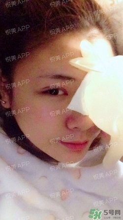 定點雙眼皮恢復過程圖_定點雙眼皮要多久恢復 定點雙眼皮恢復過程圖_定點雙眼皮要多久恢復