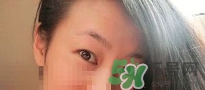 定點(diǎn)雙眼皮恢復(fù)過(guò)程圖_定點(diǎn)雙眼皮要多久恢復(fù) 定點(diǎn)雙眼皮恢復(fù)過(guò)程圖_定點(diǎn)雙眼皮要多久恢復(fù)