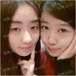 三點(diǎn)雙眼皮恢復(fù)過程圖_韓式三點(diǎn)雙眼皮多久恢復(fù)自然 三點(diǎn)雙眼皮恢復(fù)過程圖_韓式三點(diǎn)雙眼皮多久恢復(fù)自然