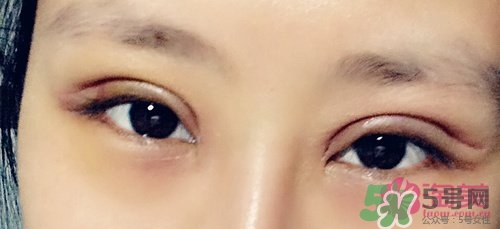 切開雙眼皮多久消腫？切開雙眼皮多久恢復(fù)？