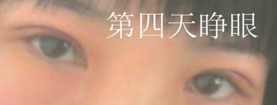 三點雙眼皮恢復(fù)過程圖_韓式三點雙眼皮多久恢復(fù)自然