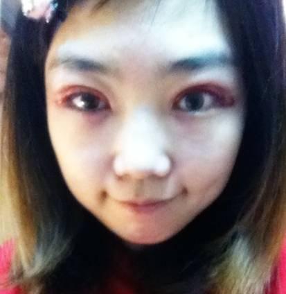 韓式三點(diǎn)雙眼皮是永久嗎？三點(diǎn)雙眼皮能保持多久？