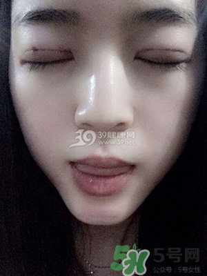 什么是定點(diǎn)雙眼皮？定點(diǎn)雙眼皮多少錢？