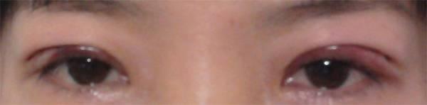 三點雙眼皮恢復(fù)過程圖_韓式三點雙眼皮多久恢復(fù)自然