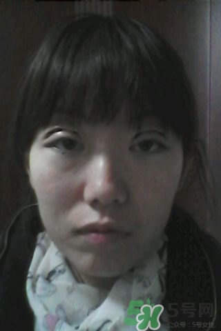 什么是定點(diǎn)雙眼皮？定點(diǎn)雙眼皮多少錢？