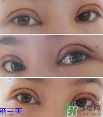 定點(diǎn)雙眼皮恢復(fù)過(guò)程圖_定點(diǎn)雙眼皮要多久恢復(fù) 定點(diǎn)雙眼皮恢復(fù)過(guò)程圖_定點(diǎn)雙眼皮要多久恢復(fù)