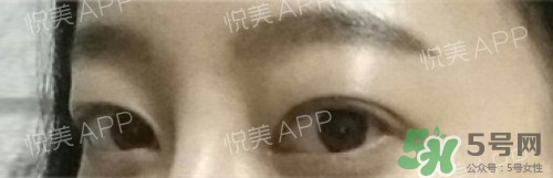 埋線雙眼皮多久恢復(fù)自然？埋線雙眼皮多久能恢復(fù)