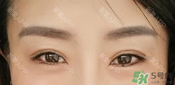 埋線(xiàn)雙眼皮能保持多久？埋線(xiàn)雙眼皮是永久嗎