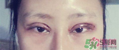 切開雙眼皮多久消腫？切開雙眼皮多久恢復(fù)？
