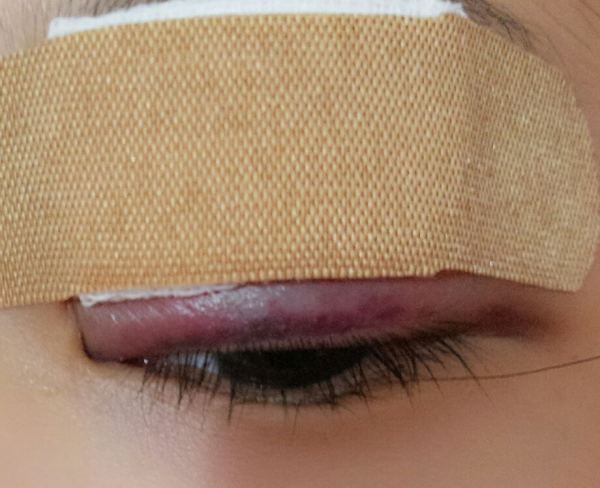 定點(diǎn)雙眼皮恢復(fù)過(guò)程圖_定點(diǎn)雙眼皮要多久恢復(fù) 定點(diǎn)雙眼皮恢復(fù)過(guò)程圖_定點(diǎn)雙眼皮要多久恢復(fù)