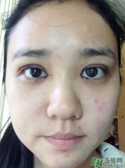 埋線雙眼皮的危害_埋線雙眼皮有風險后遺癥嗎 埋線雙眼皮的危害_埋線雙眼皮有風險后遺癥嗎