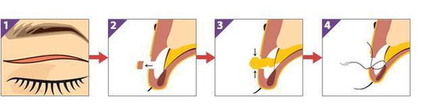定點雙眼皮怎么做？定點雙眼皮需要拆線嗎？