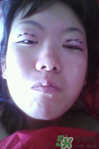 什么是定點(diǎn)雙眼皮？定點(diǎn)雙眼皮多少錢？